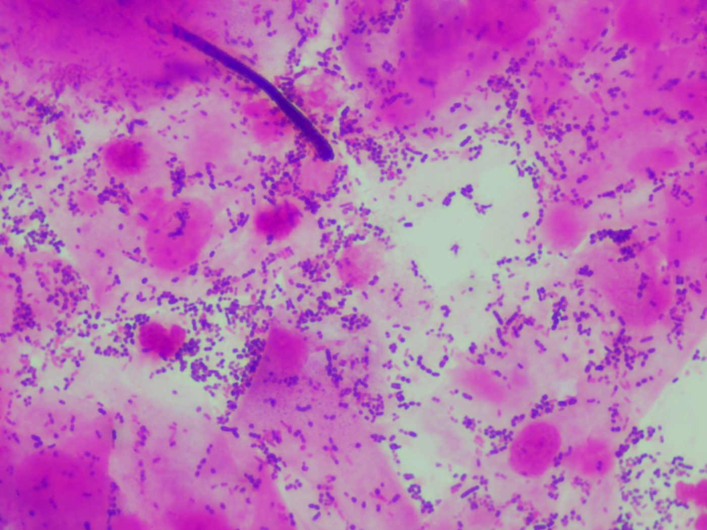 Microscopia de infecção mista: candidíase e vaginose bacteriana